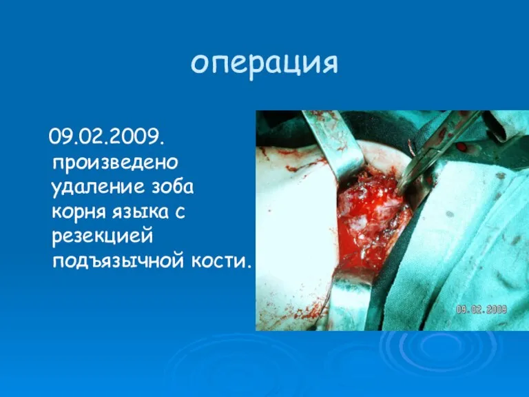 операция 09.02.2009. произведено удаление зоба корня языка с резекцией подъязычной кости.