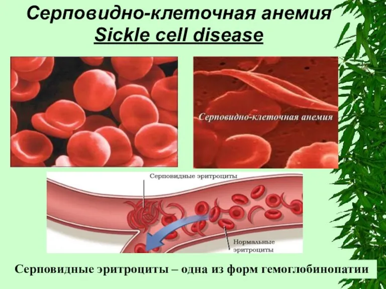 Серповидно-клеточная анемия Sickle cell disease Серповидные эритроциты – одна из форм гемоглобинопатии