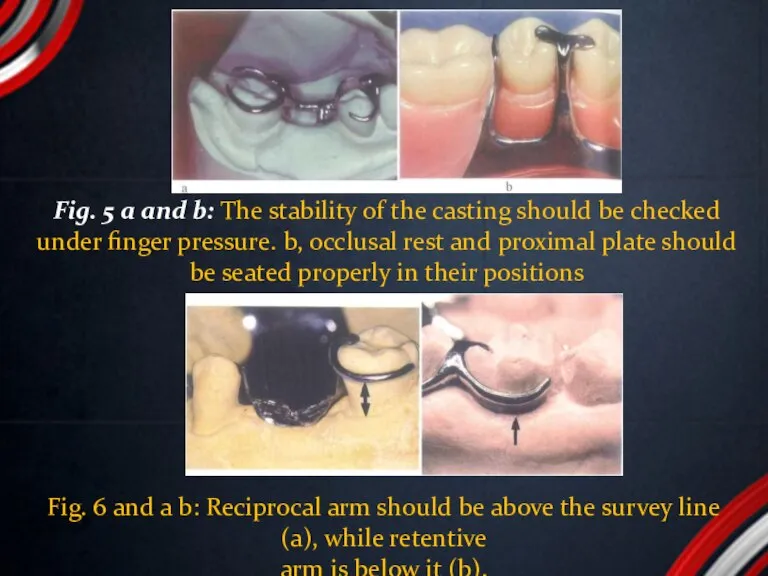 Fig. 5 a and b: The stability of the casting should be