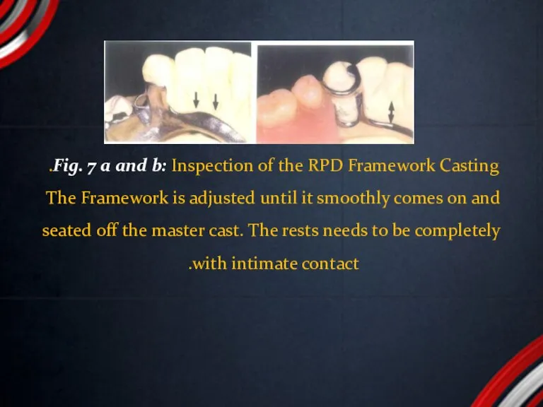Fig. 7 a and b: Inspection of the RPD Framework Casting. The