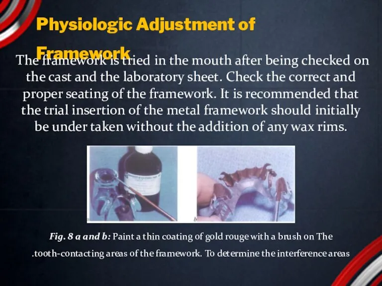 Physiologic Adjustment of Framework The framework is tried in the mouth after