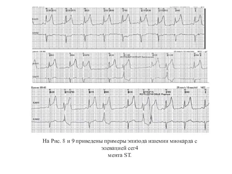 На Рис. 8 и 9 приведены примеры эпизода ишемии миокарда с элевацией сег4 мента ST.