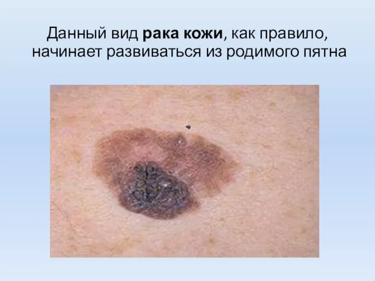 Данный вид рака кожи, как правило, начинает развиваться из родимого пятна