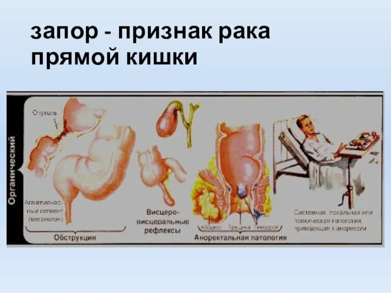 запор - признак рака прямой кишки