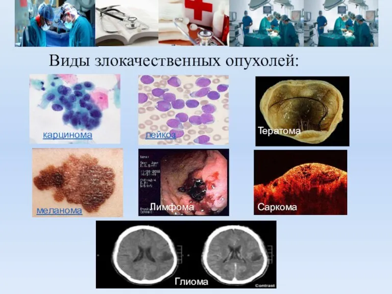 меланома карцинома лейкоз Лимфома Саркома Тератома Глиома Виды злокачественных опухолей: