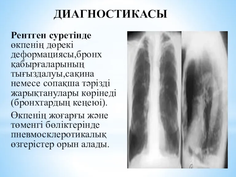 Рентген суретінде өкпенің дөрекі деформациясы,бронх қабырғаларының тығыздалуы,сақина немесе сопақша тәрізді жарықтанулары көрінеді(бронхтардың