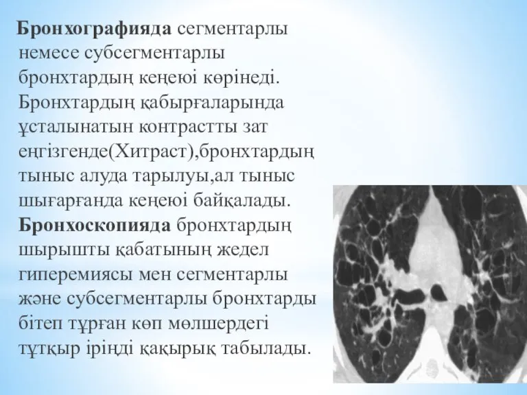 Бронхографияда сегментарлы немесе субсегментарлы бронхтардың кеңеюі көрінеді.Бронхтардың қабырғаларында ұсталынатын контрастты зат еңгізгенде(Хитраст),бронхтардың