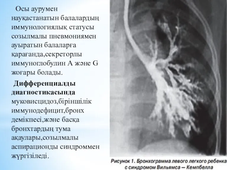 Осы аурумен науқастанатын балалардың иммунологиялық статусы созылмалы пневмониямен ауыратын балаларға қарағанда,секреторлы иммуноглобулин