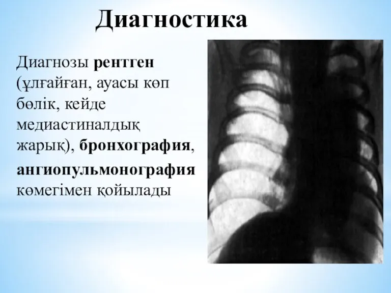 Диагностика Диагнозы рентген (ұлғайған, ауасы көп бөлік, кейде медиастиналдық жарық), бронхография, ангиопульмонография көмегімен қойылады