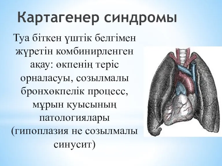 Картагенер синдромы Туа біткен үштік белгімен жүретін комбинирленген ақау: өкпенің теріс орналасуы,