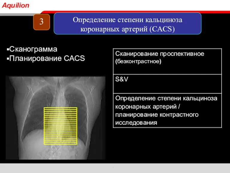 Сканограмма Планирование CACS 3 Определение степени кальциноза коронарных артерий (CACS) Aquilion