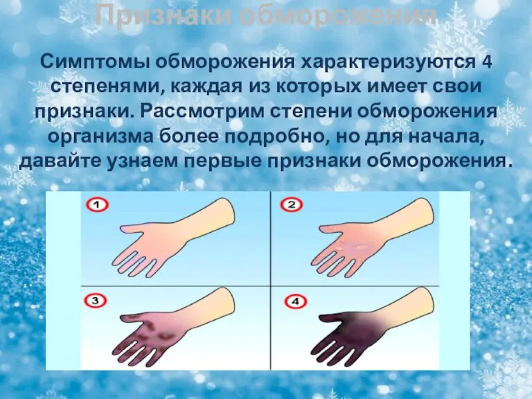 Признаки обморожения Симптомы обморожения характеризуются 4 степенями, каждая из которых имеет свои