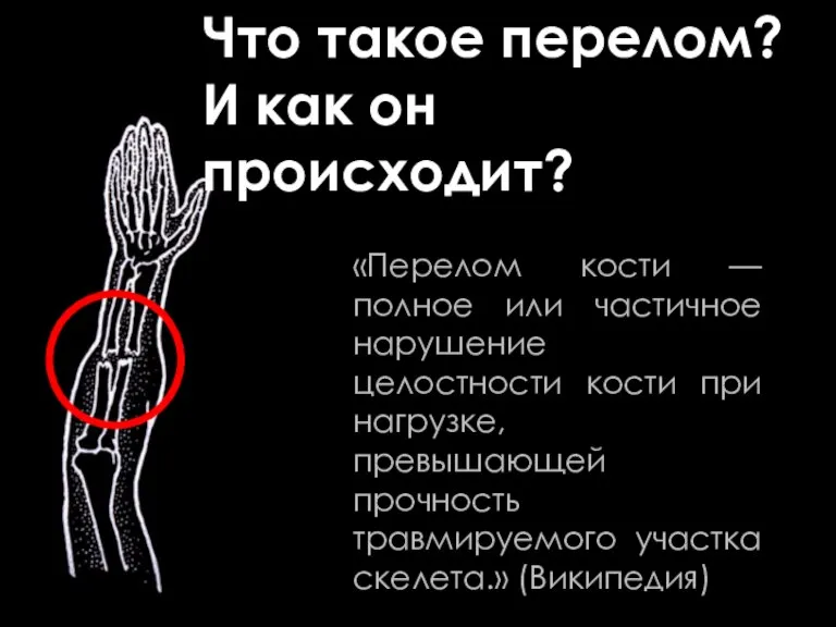 «Перелом кости — полное или частичное нарушение целостности кости при нагрузке, превышающей