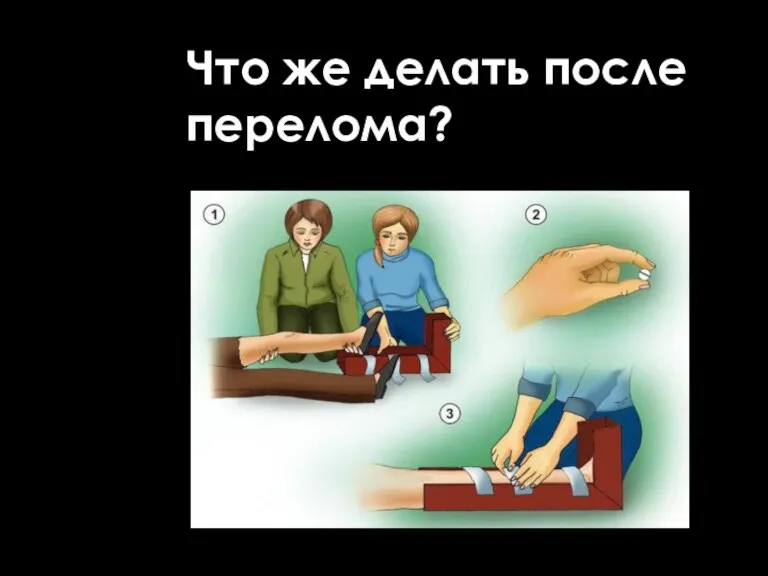 Что же делать после перелома?