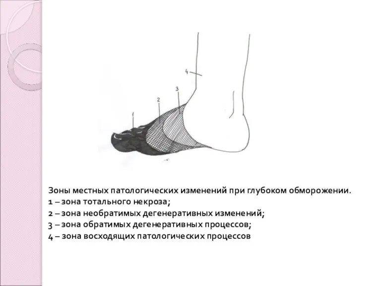 Зоны местных патологических изменений при глубоком обморожении. 1 – зона тотального некроза;