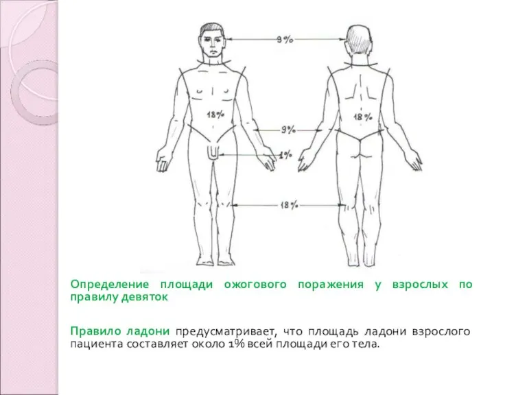 Определение площади ожогового поражения у взрослых по правилу девяток Правило ладони предусматривает,