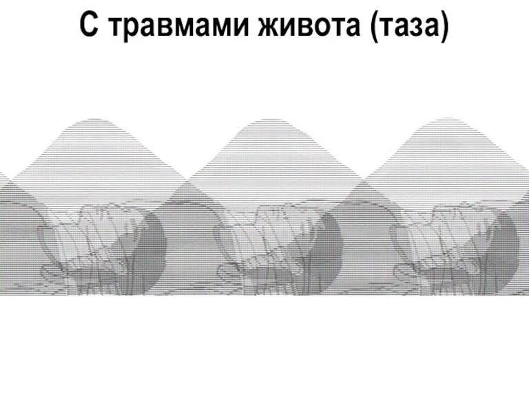 С травмами живота (таза)