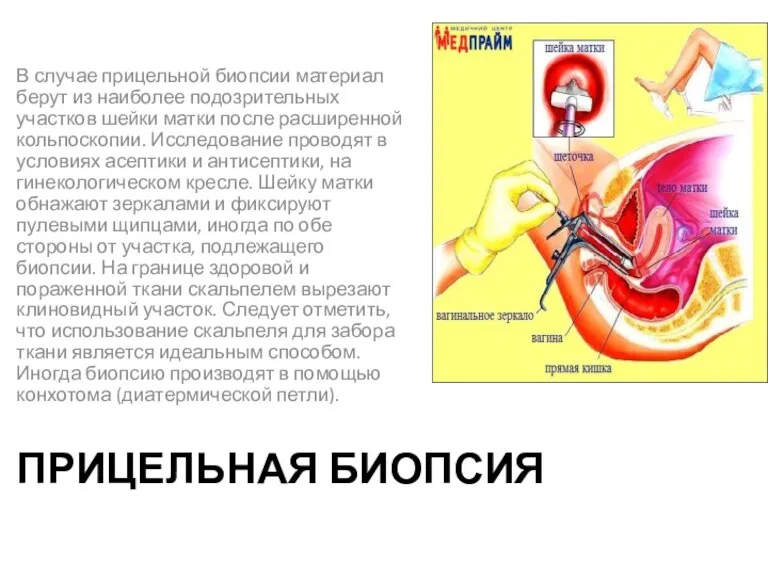 ПРИЦЕЛЬНАЯ БИОПСИЯ В случае прицельной биопсии материал берут из наиболее подозрительных участков