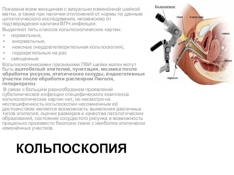 КОЛЬПОСКОПИЯ Показана всем женщинам с визуально изменённой шейкой матки, а также при