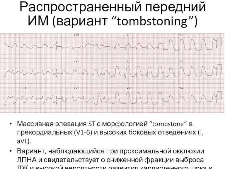 Распространенный передний ИМ (вариант “tombstoning”) Массивная элевация ST с морфологией “tombstone” в