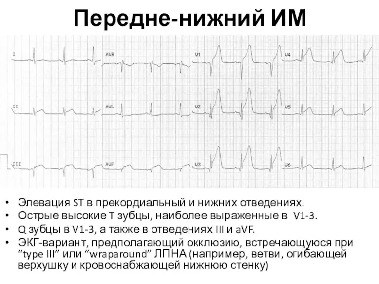 Передне-нижний ИМ Элевация ST в прекордиальный и нижних отведениях. Острые высокие T