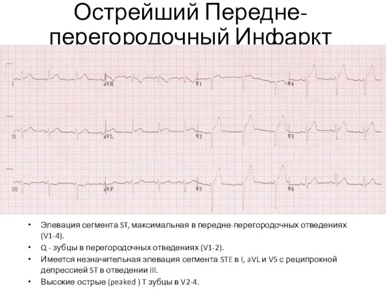 Острейший Передне-перегородочный Инфаркт Элевация сегмента ST, максимальная в передне-перегородочных отведениях (V1-4). Q