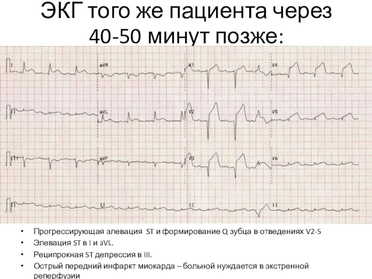 ЭКГ того же пациента через 40-50 минут позже: Прогрессирующая элевация ST и