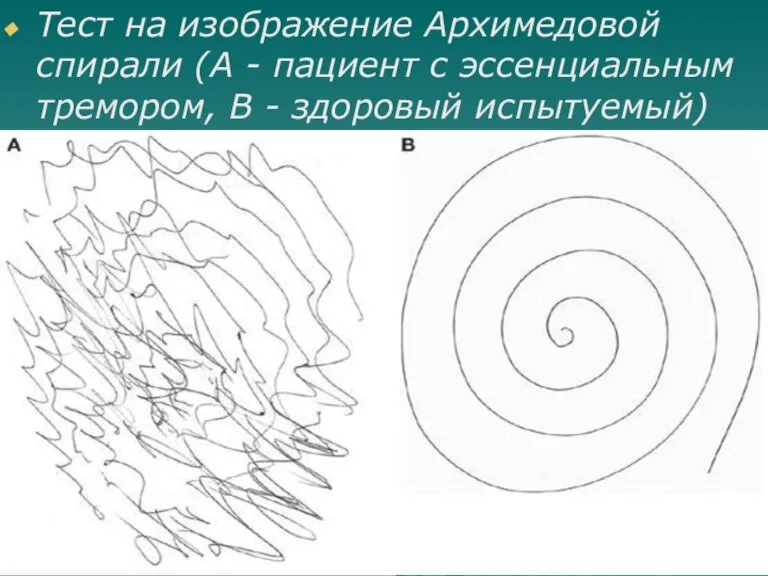 Тест на изображение Архимедовой спирали (А - пациент с эссенциальным тремором, В - здоровый испытуемый)