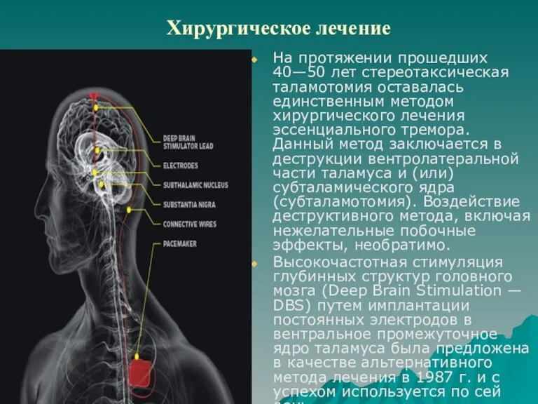 Хирургическое лечение На протяжении прошедших 40—50 лет стереотаксическая таламотомия оставалась единственным методом