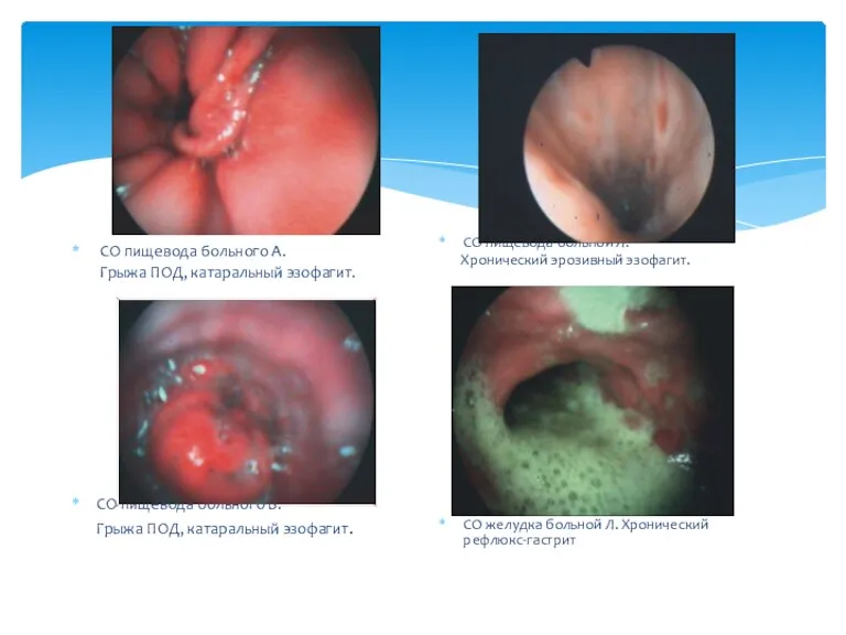 СО пищевода больного А. Грыжа ПОД, катаральный эзофагит. СО пищевода больного Б.