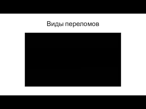 Виды переломов