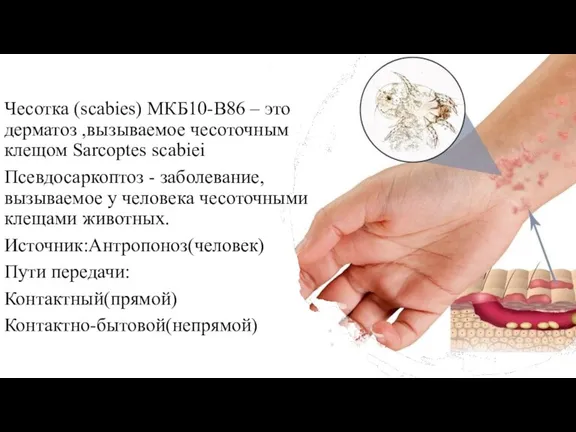 Чесотка (scabies) МКБ10-В86 – это дерматоз ,вызываемое чесоточным клещом Sarcoptes scabiei Псевдосаркоптоз