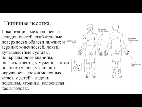 Типичная чесотка. Локализация: межпальцевые складки кистей, сгибательные поверхности области нижних и верхних