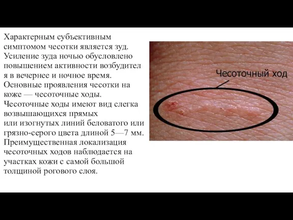 Характерным субъективным симптомом чесотки является зуд. Усиление зуда ночью обусловлено повышением активности