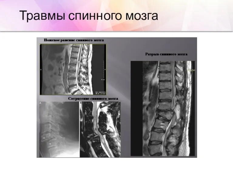 Травмы спинного мозга