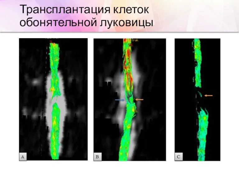 Трансплантация клеток обонятельной луковицы