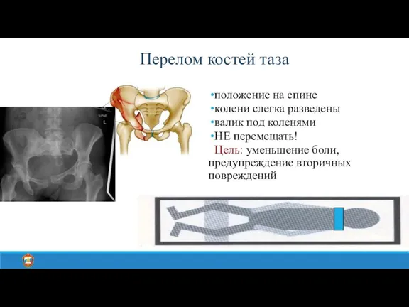 Перелом костей таза положение на спине колени слегка разведены валик под коленями