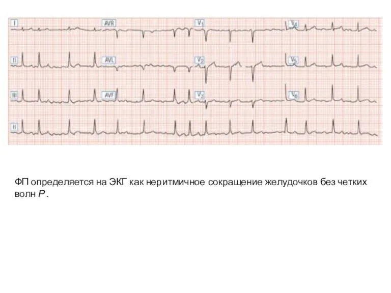 ФП определяется на ЭКГ как неритмичное сокращение желудочков без четких волн Р .