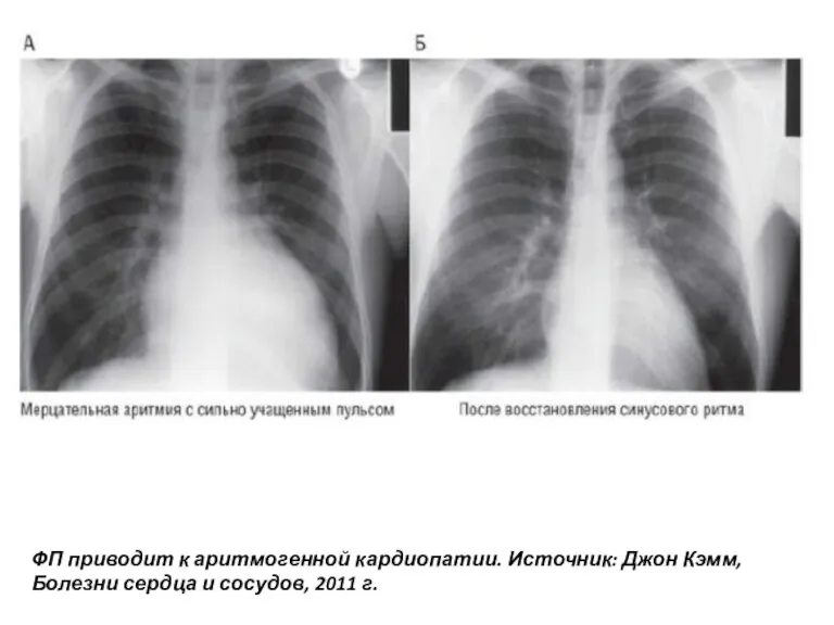 ФП приводит к аритмогенной кардиопатии. Источник: Джон Кэмм, Болезни сердца и сосудов, 2011 г.