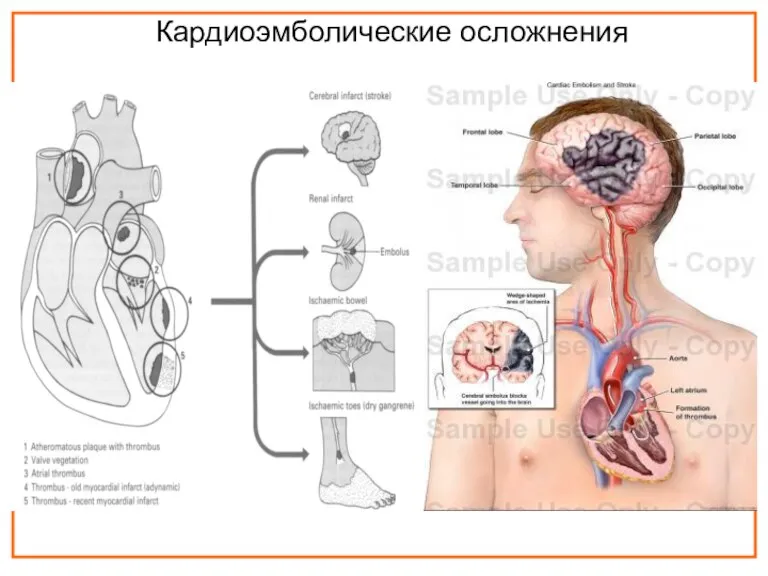 Кардиоэмболические осложнения