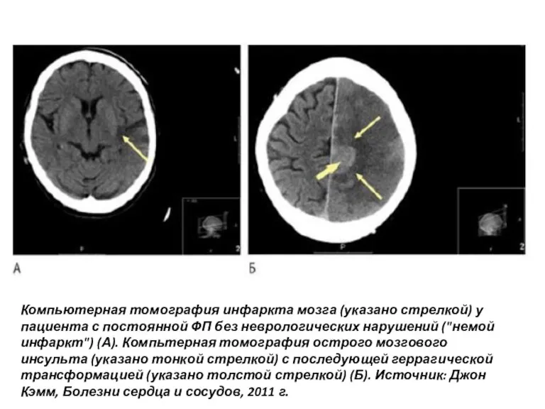 Компьютерная томография инфаркта мозга (указано стрелкой) у пациента с постоянной ФП без