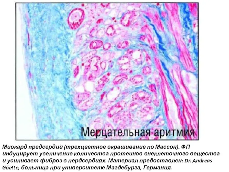 Миокард предсердий (трехцветное окрашивание по Массон). ФП индуцирует увеличение количества протеинов внеклеточного