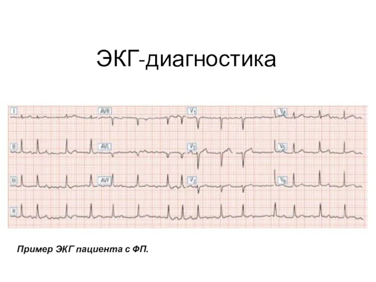 Пример ЭКГ пациента с ФП. ЭКГ-диагностика