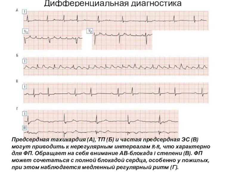 Дифференциальная диагностика Предсердная тахикардия (А), ТП (Б) и частая предсердная ЭС (В)