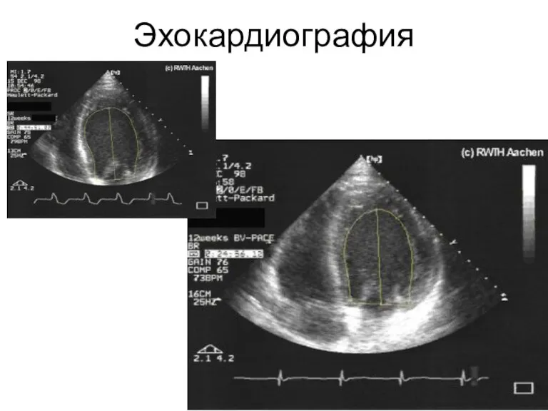 Эхокардиография