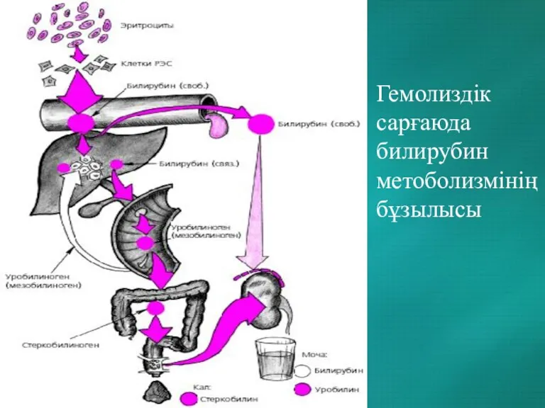 Гемолиздік сарғаюда билирубин метоболизмінің бұзылысы