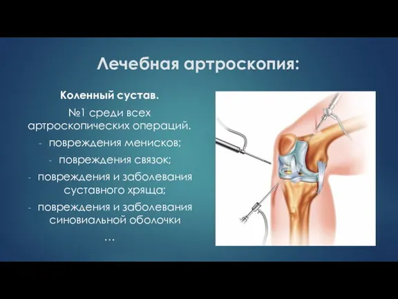 Лечебная артроскопия: Коленный сустав. №1 среди всех артроскопических операций. повреждения менисков; повреждения