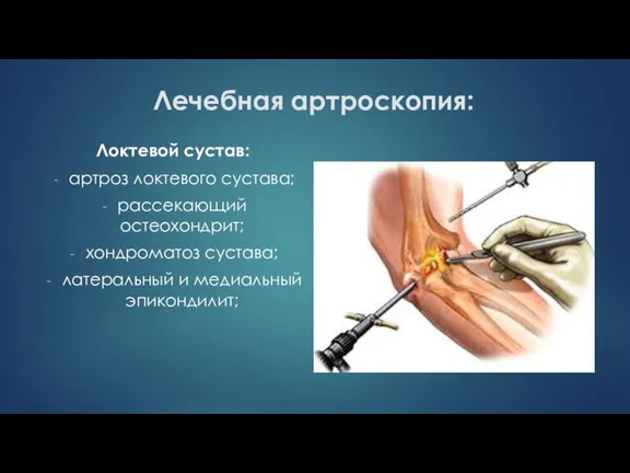 Лечебная артроскопия: Локтевой сустав: артроз локтевого сустава; рассекающий остеохондрит; хондроматоз сустава; латеральный и медиальный эпикондилит;
