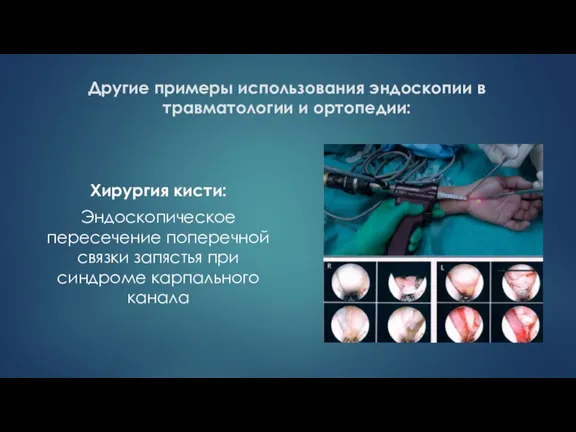 Другие примеры использования эндоскопии в травматологии и ортопедии: Хирургия кисти: Эндоскопическое пересечение