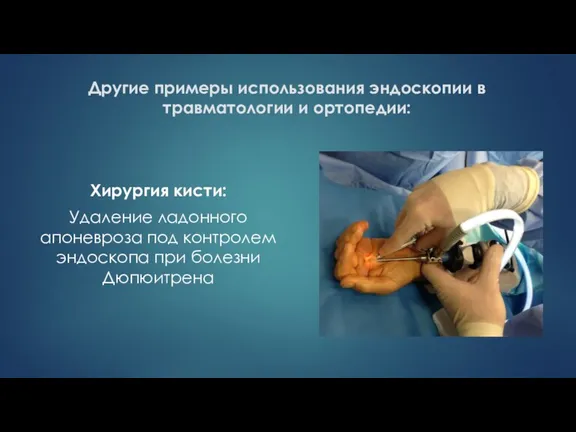 Другие примеры использования эндоскопии в травматологии и ортопедии: Хирургия кисти: Удаление ладонного
